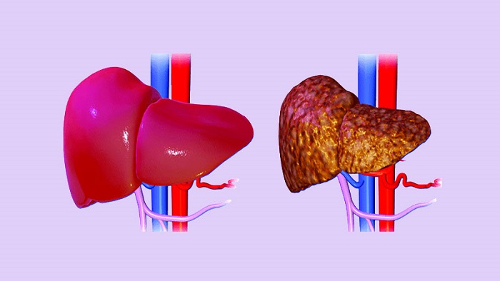 সুস্থ লিভার ও অসুস্থ লিভার