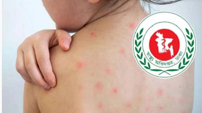 সারা দেশে হাম ও উপসর্গে আরও ৯ শিশুর মৃত্যু